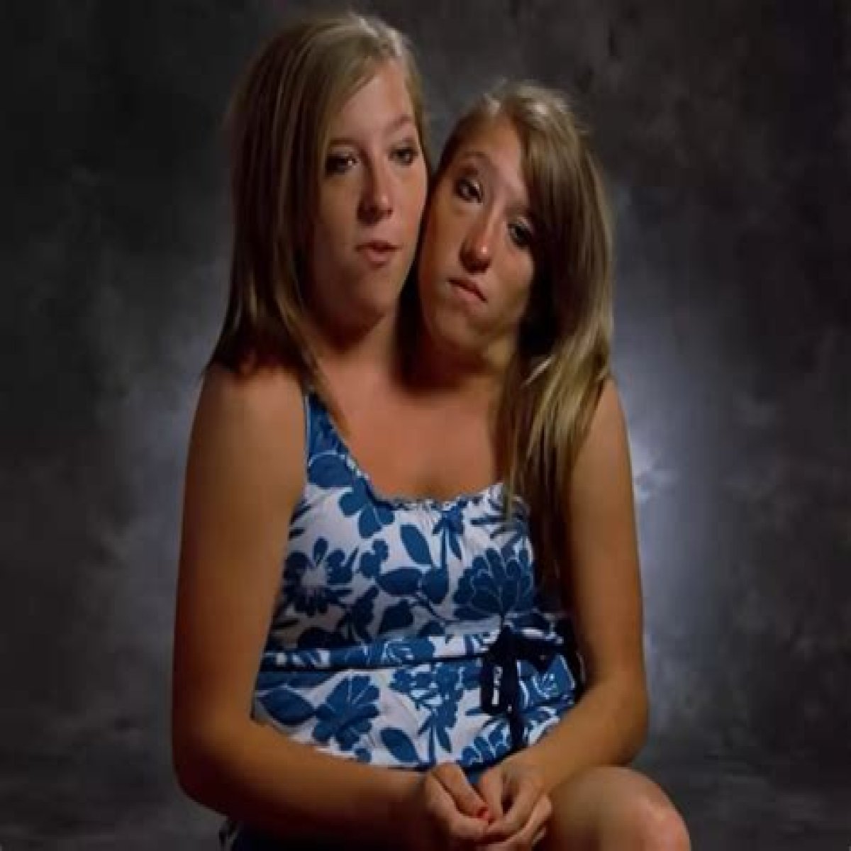 Exploring The Journey Of Conjoined Twins Pregnant: A Unique Perspective On Life And Love