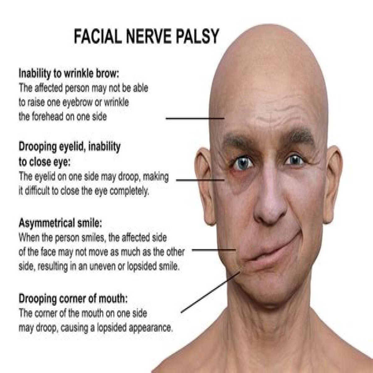 Resilience And Hope Amidst Illness And Facial Paralysis
