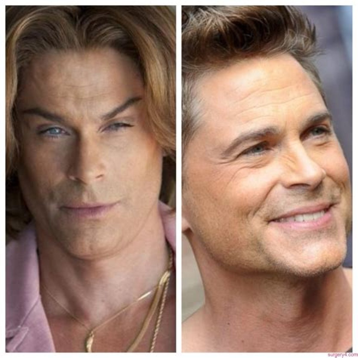 Rob Lowe's Plastic Surgery Exposed
