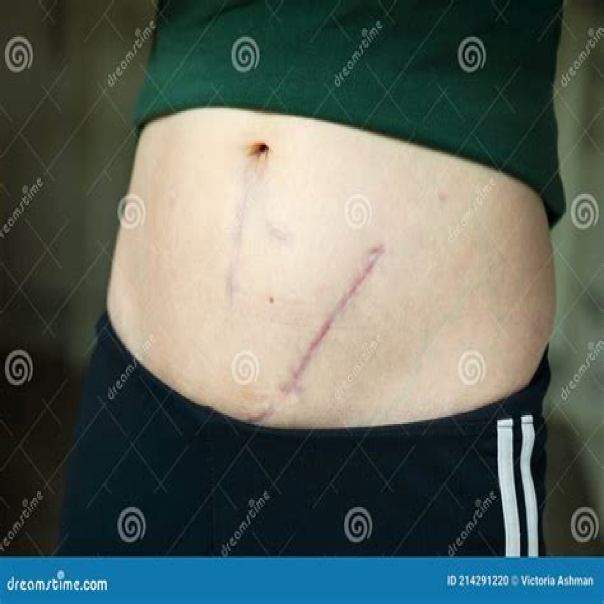 The Ultimate Guide To Kidney Transplant Surgery Scars: Everything You Need To Know