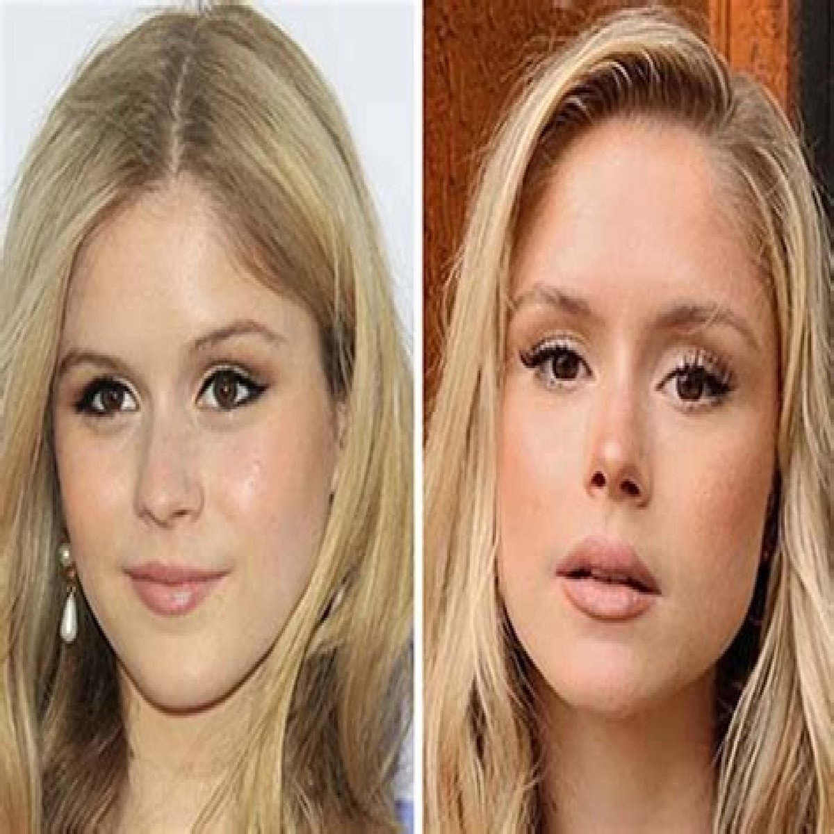 Transformations Revealed: The Journey Of Actress Plastic Surgery Before And After