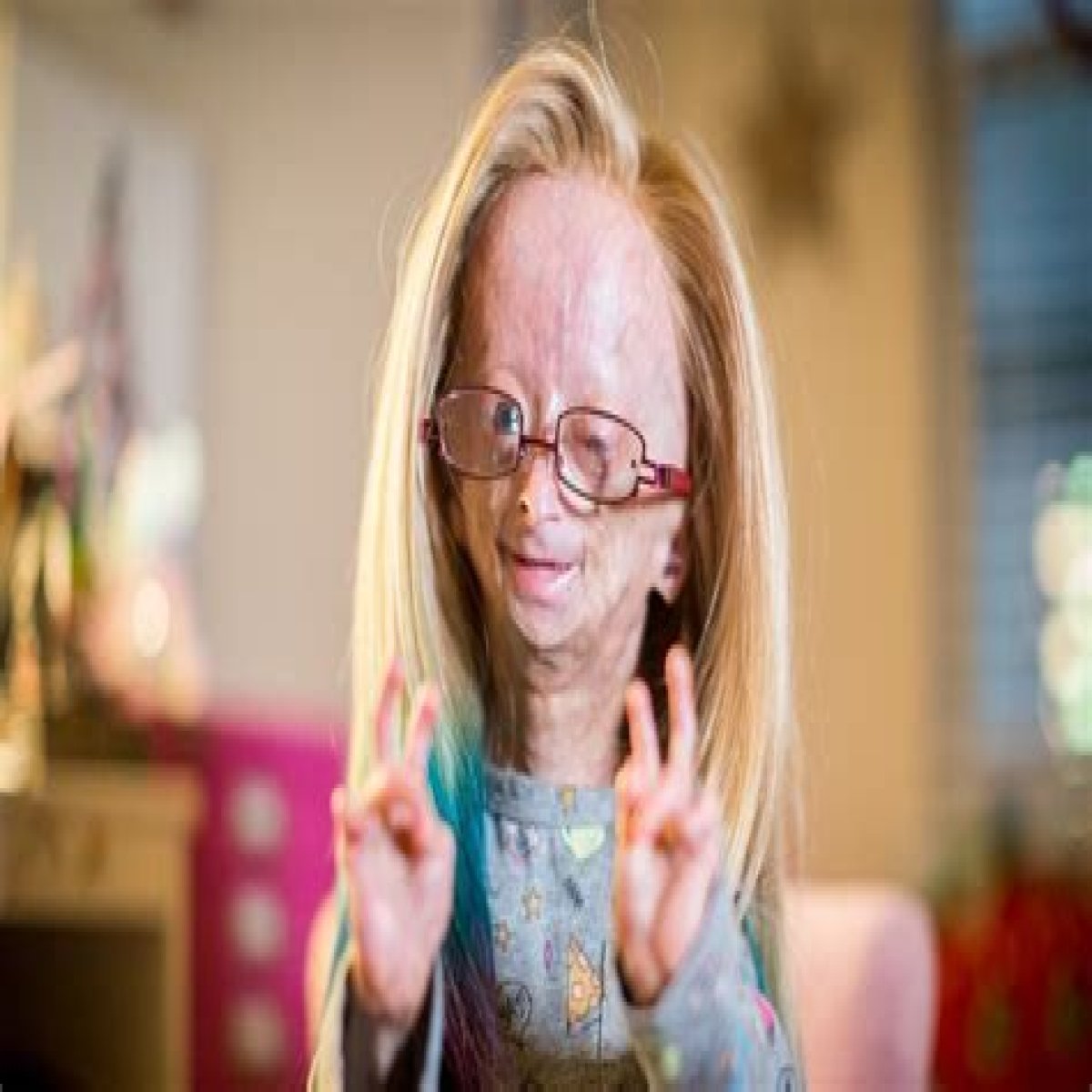 Understanding The Life And Legacy Of Adalia Rose: What Age Did She Die?